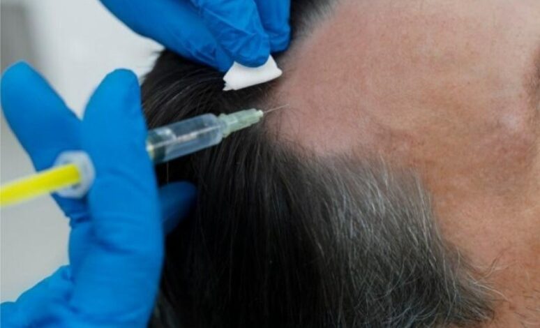 Leading Innovations in Hair Transplantation with Hairtec